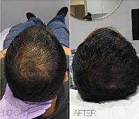 PRP Hair Loss & Hair Restoration image 2